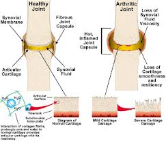 Arthritic Joint